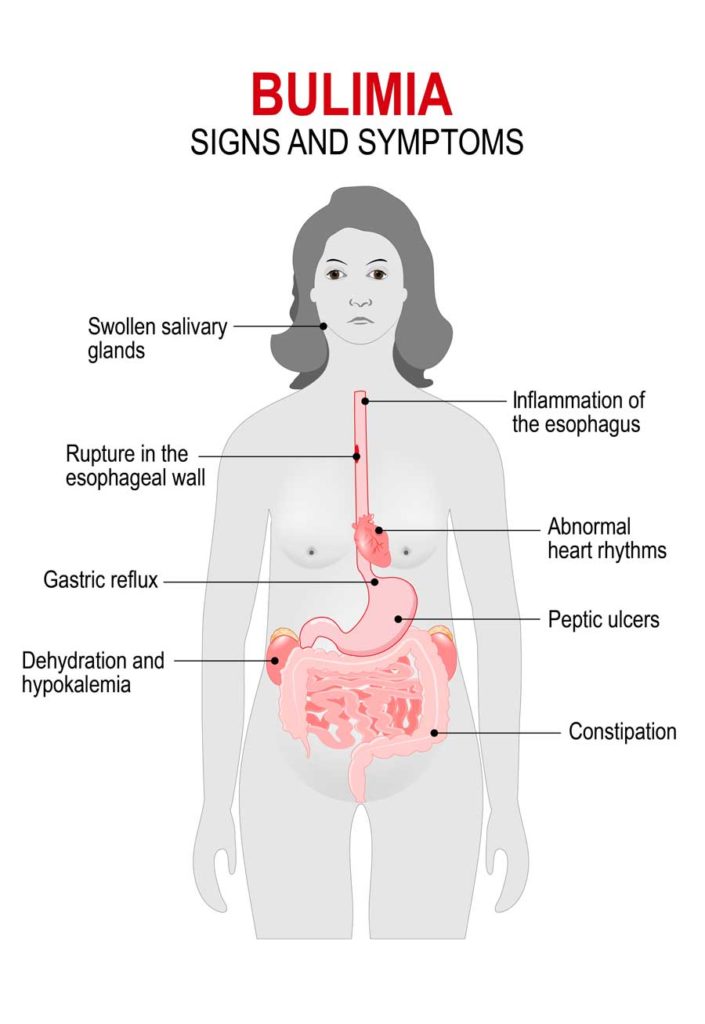 Bulimia Signs & Symptoms Eating Disorder Solutions of Dallas Texas